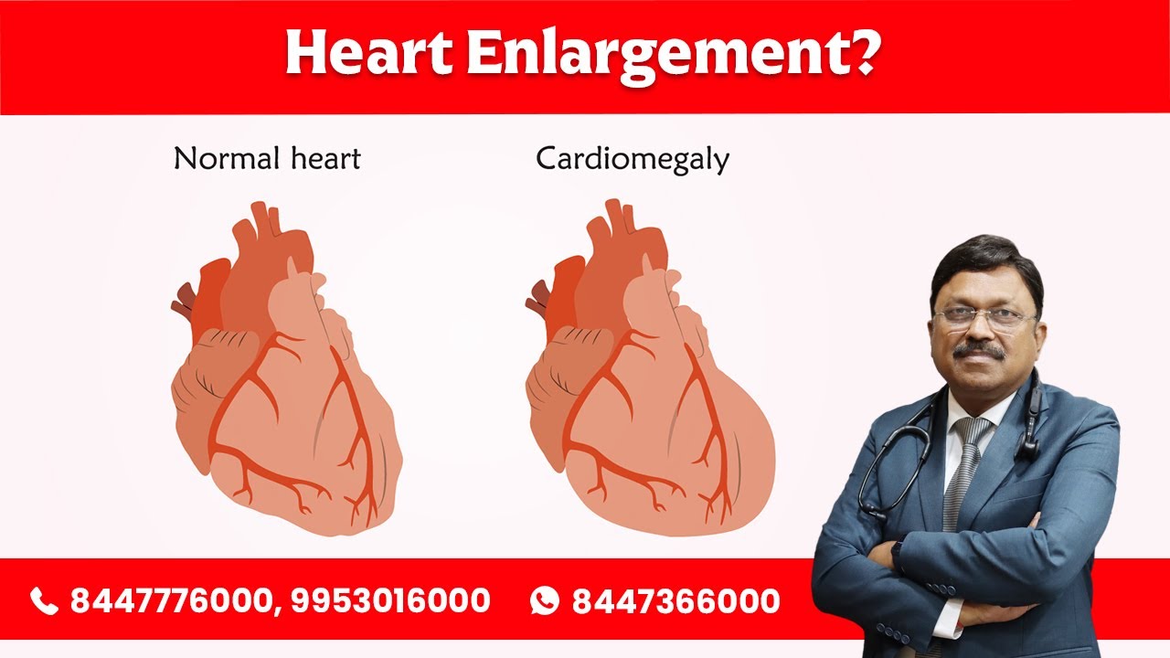 Heart Enlargement? by Dr. Bimal Chhajer
