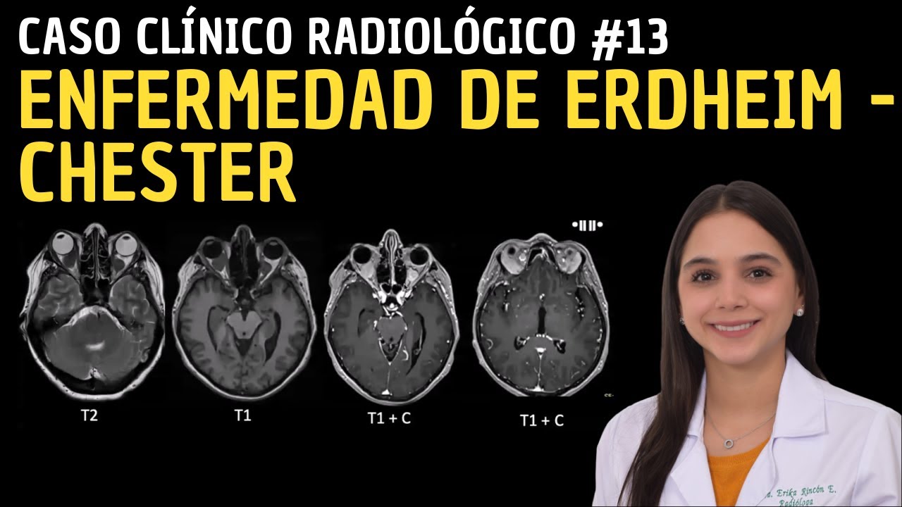 Caso Clínico 13: Enfermedad de Erdheim - Chester