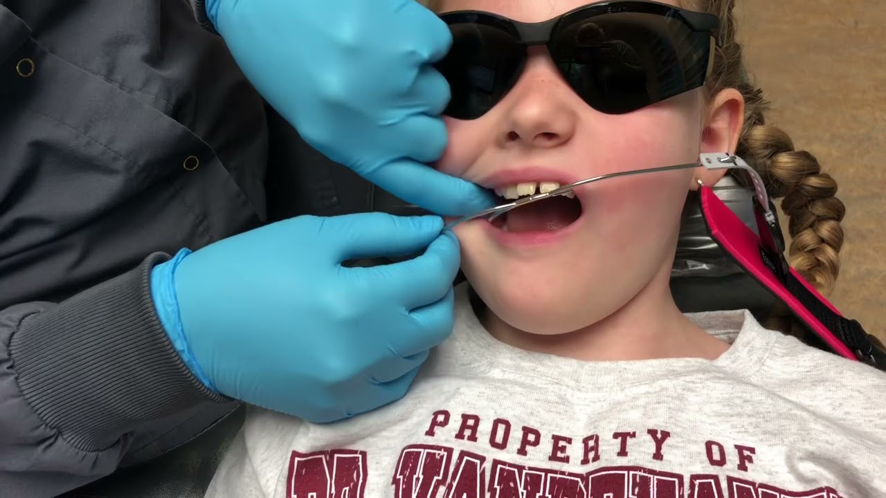 Getting braces part 3 (headgear)