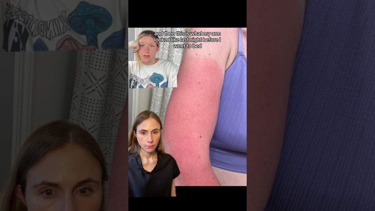She Put Noxema On A Sunburn 🤦&zwj;♀️