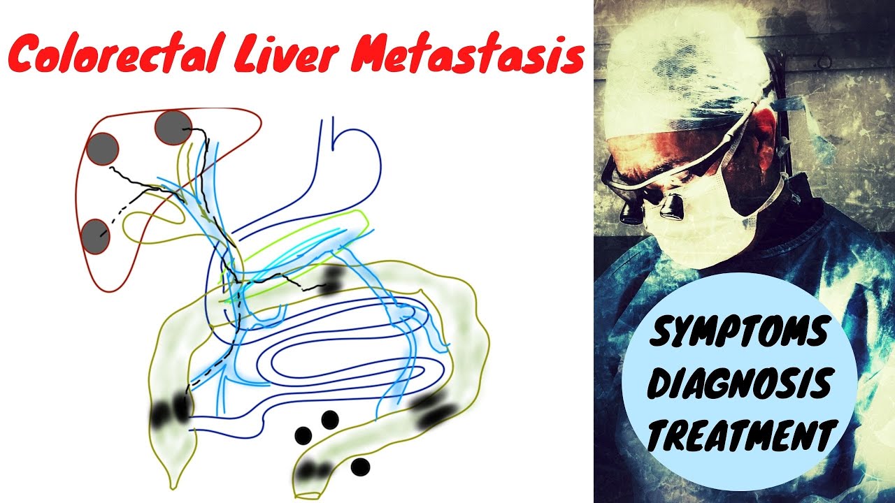 Stage 4 Colon Cancer (Liver Metastasis); Symptoms Diagnosis Treatment