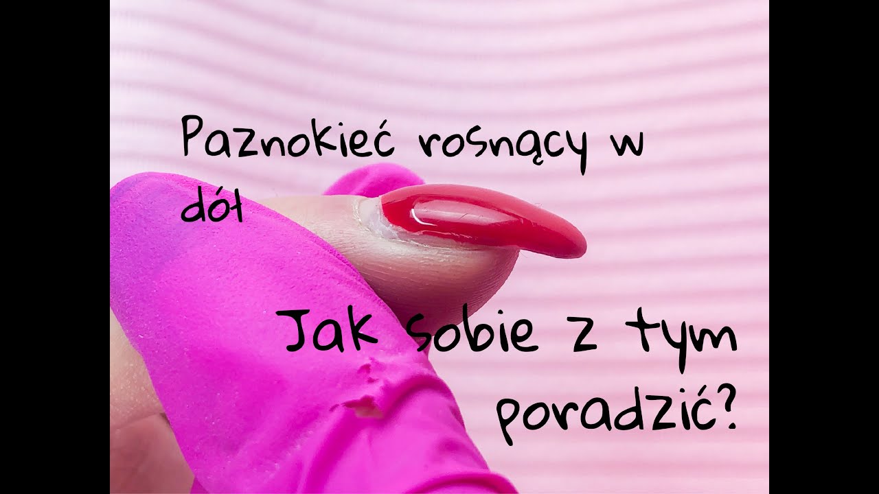 Paznokieć rosnący w dół krok po kroku. Paznokcie żelowe bardzo łatwy sposób