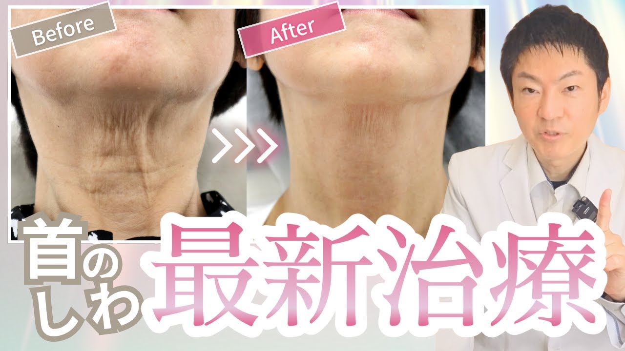 【最新治療】首のシワ改善はここまで進化！レニスナ×レーザー徹底解説【ポリ乳酸注射】