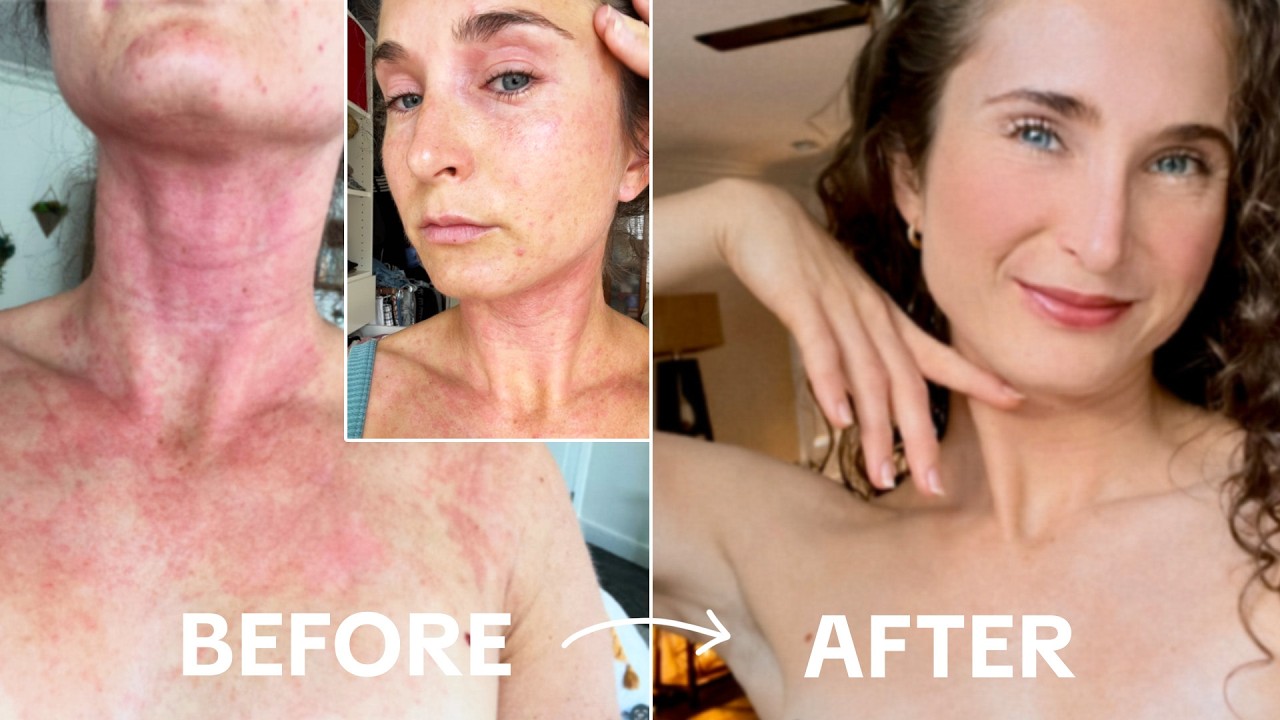 How I Healed My Skin Barrier Overnight // at home, affordable eczema & acne healing skincare