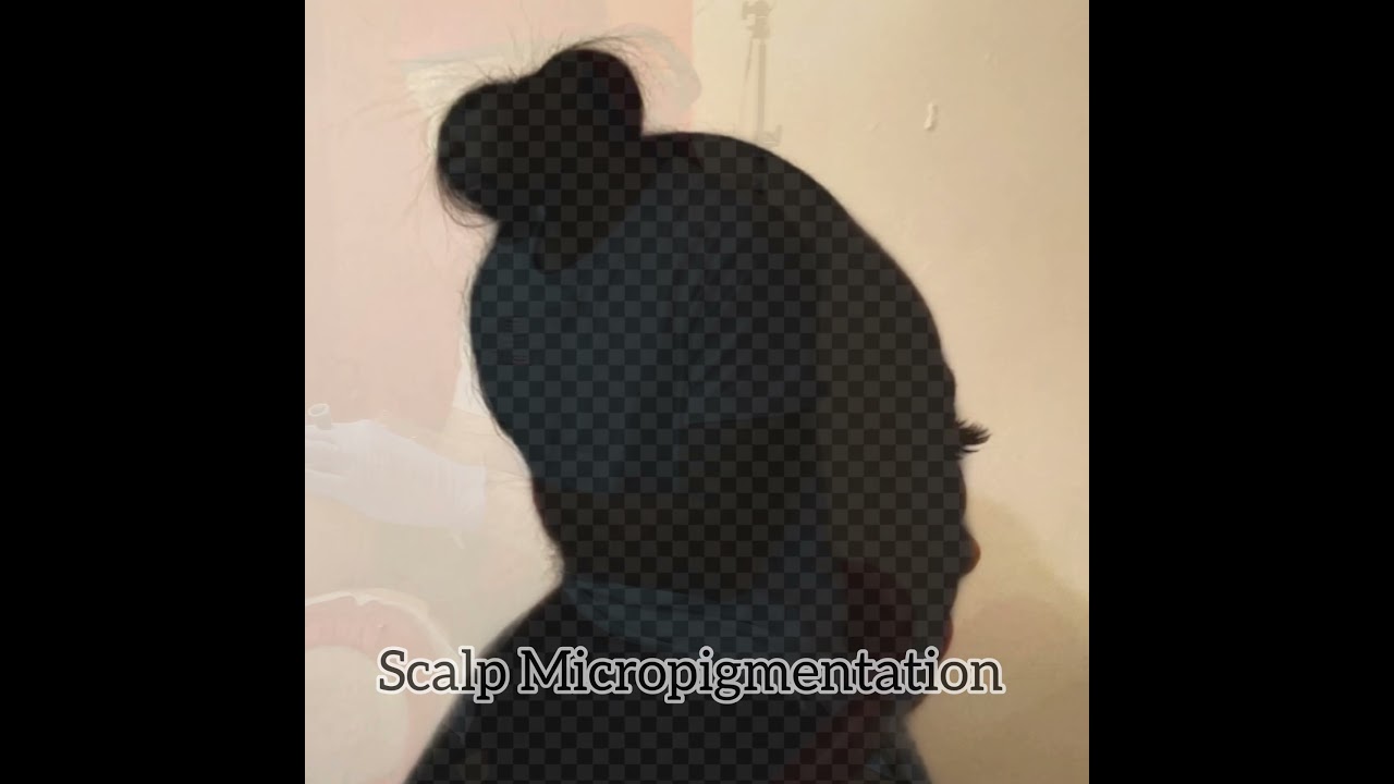 Chisel Scalp SMP Procedure 19 - Female (Hair Loss Solution)