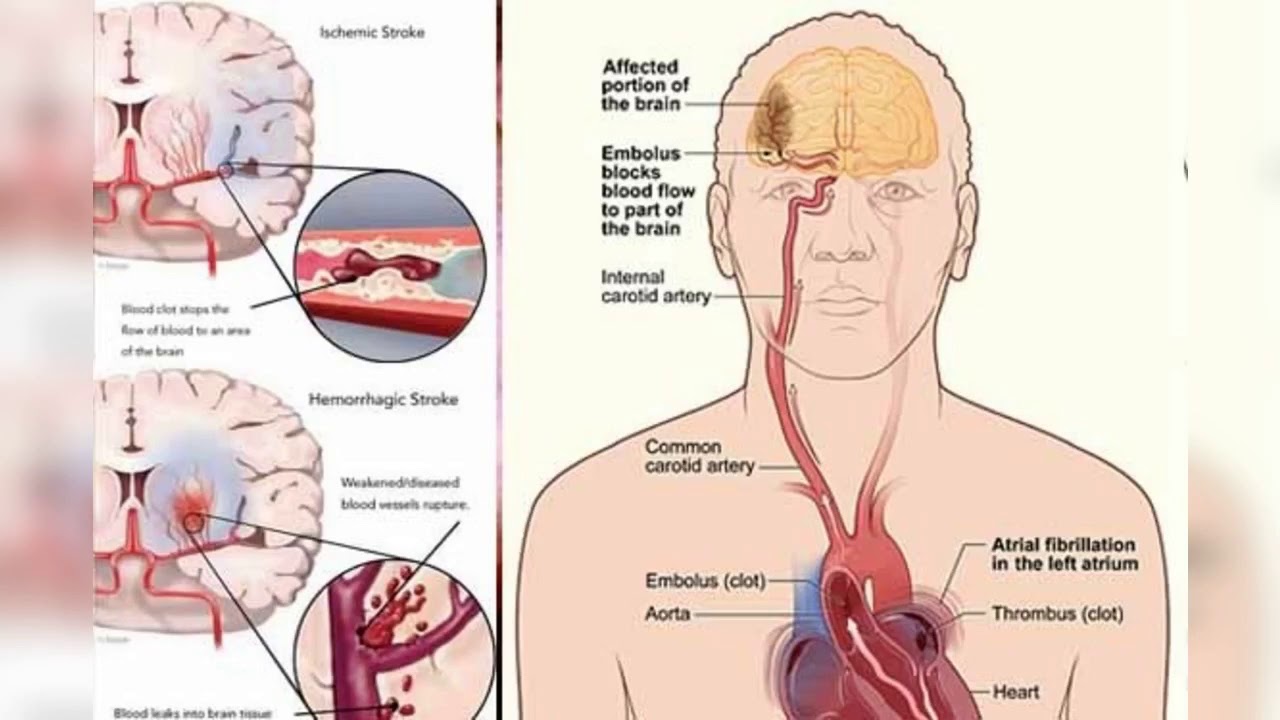 RUQYAH YANG DAPAT MERAWAT MENYAKIT STROKE ,LUMPUH, ANGIN AHMAR