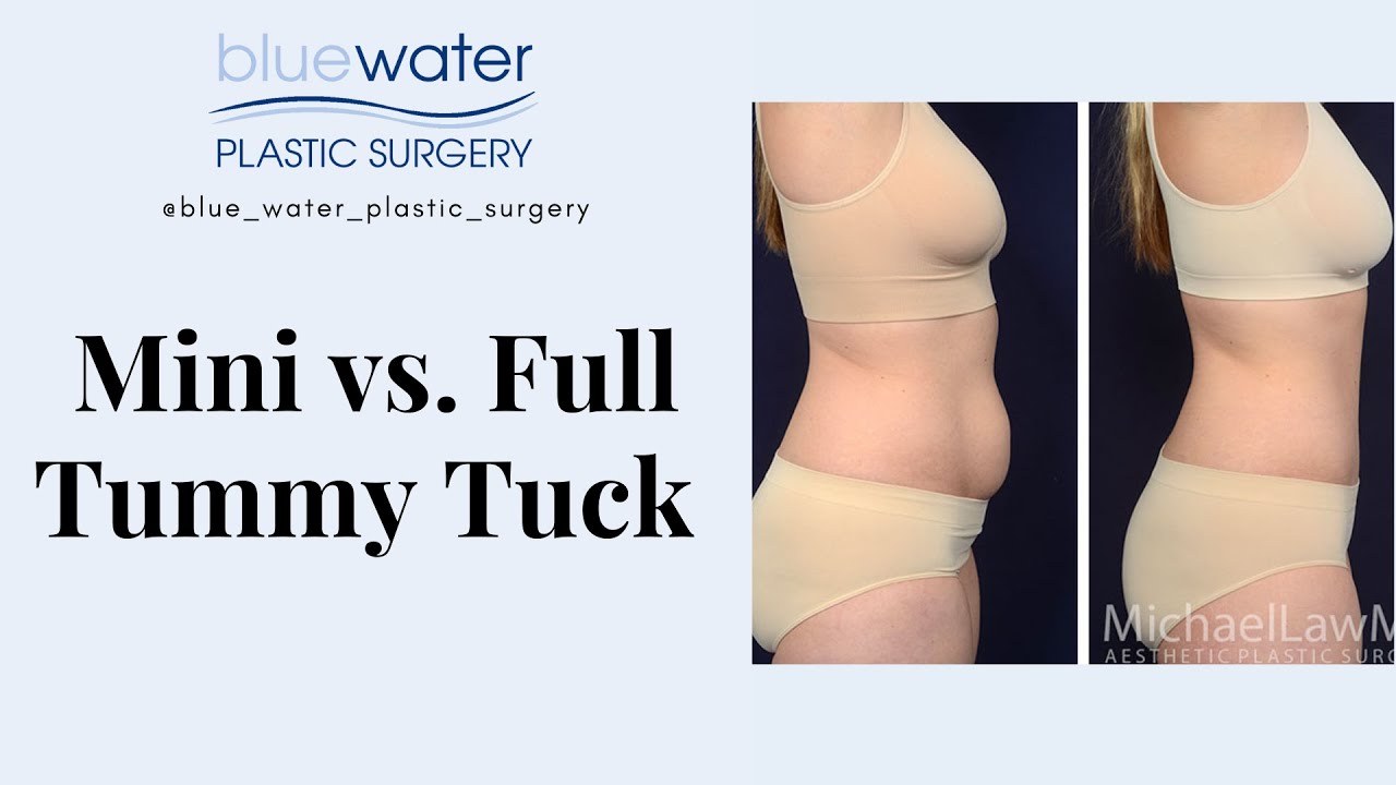 Mini vs  full tummy tuck