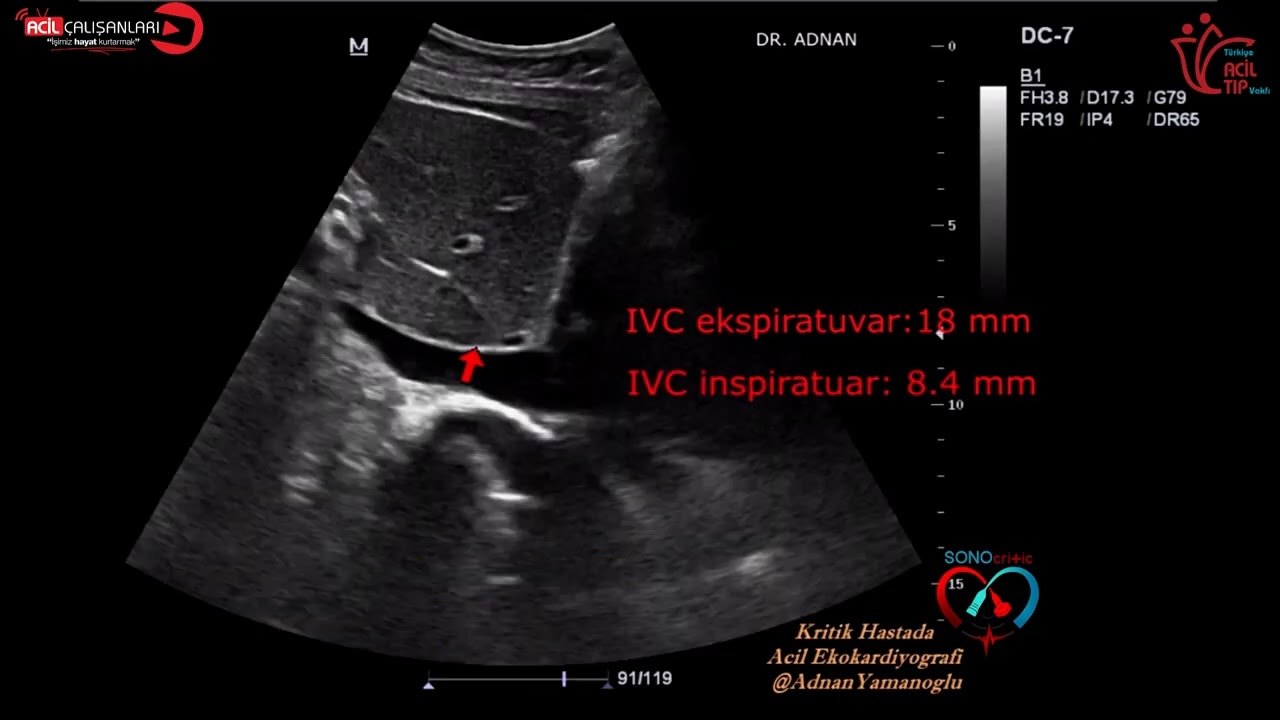 İnferior Vena Cava Çapı İle Volüm Durumu Takibi