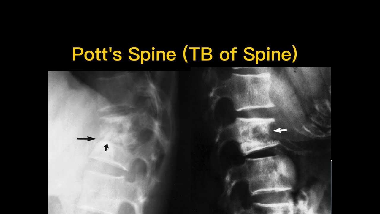 Pott's spine and TB of hip