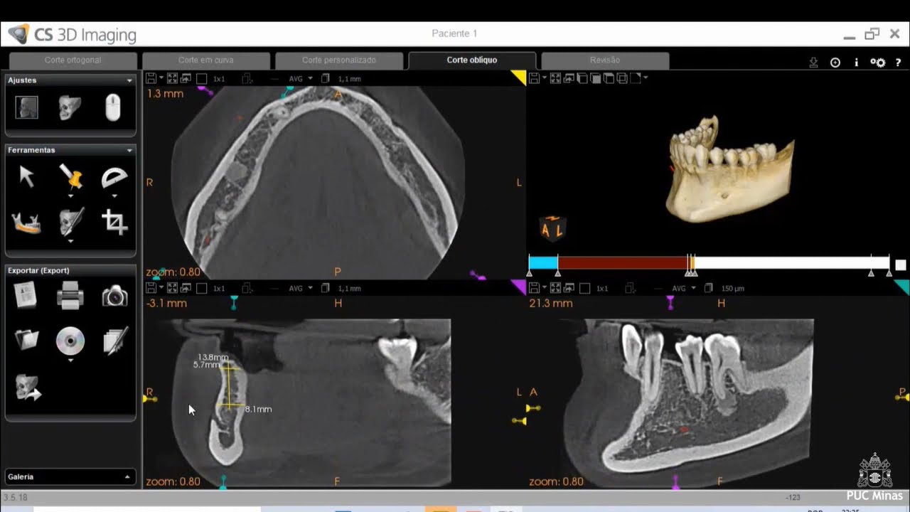 Gota #133 FERRAMENTAS BÁSICAS DO CS 3D IMAGING SOFTWARE PARA MANIPULAÇÃO DE TC DE FEIXE CÔNICO