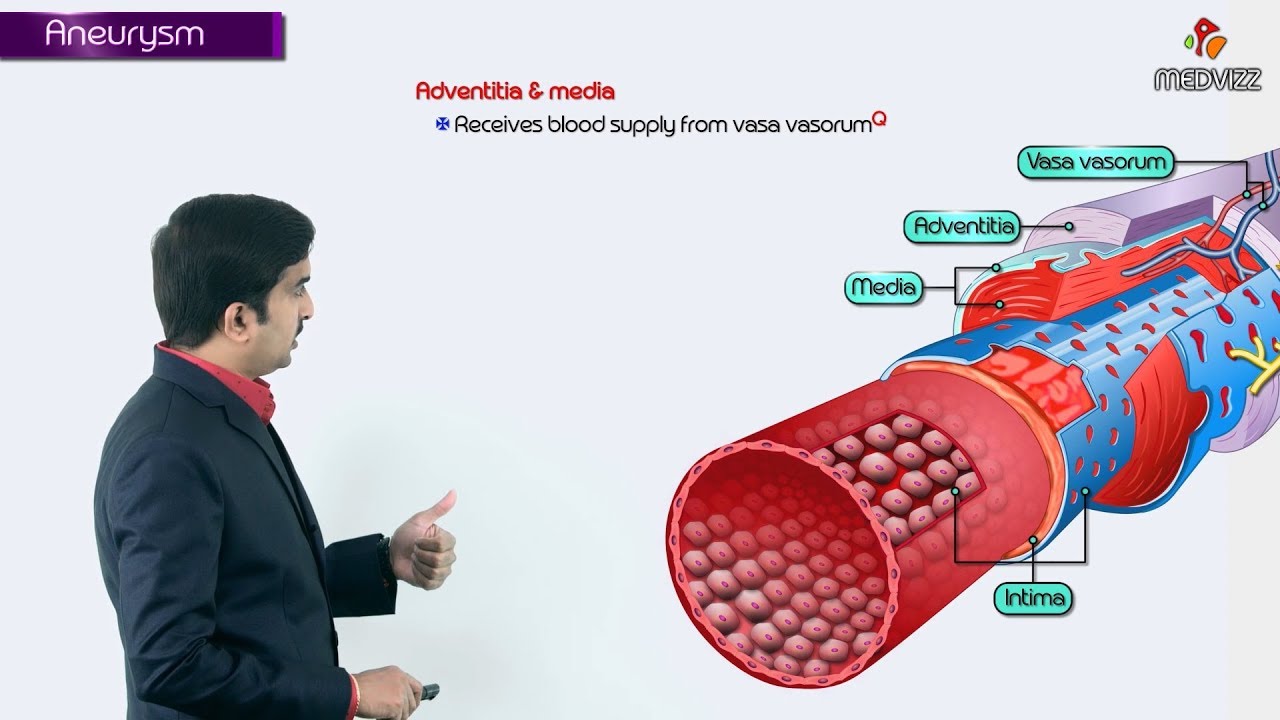 Pathophysiology of Aneurysms Usmle Step 1: Dr G Bhanu Prakash