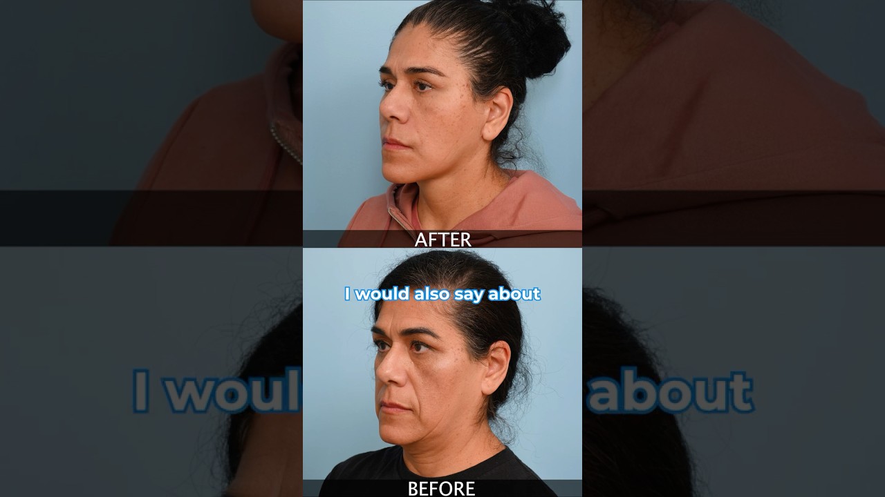Deep Plane Facelift Recovery: What You Need to Know #FaceliftRecovery