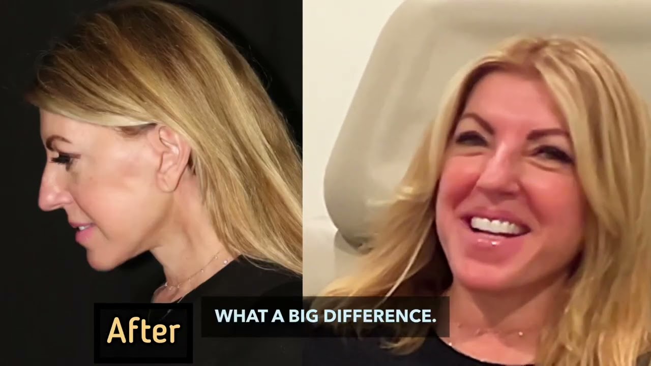Facelift Recovery at 6 weeks after a deep plane facelift  and neck lift