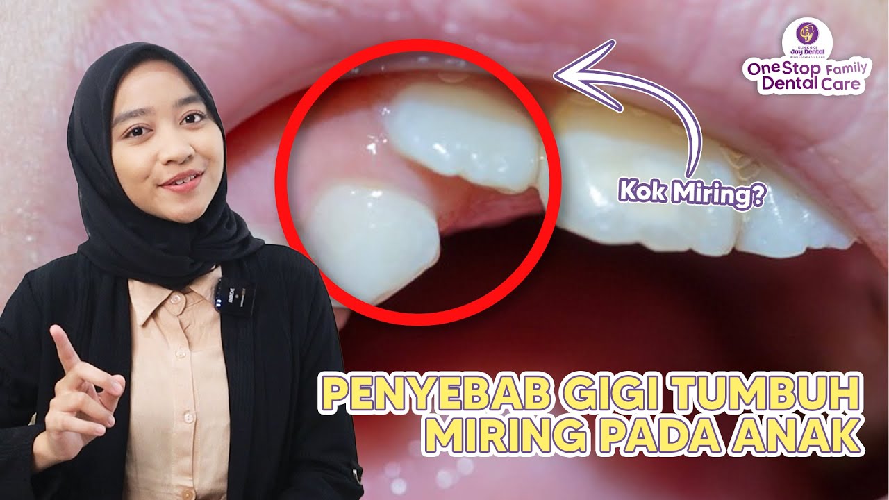 KENAPA GIGI ANAK BISA MIRING?