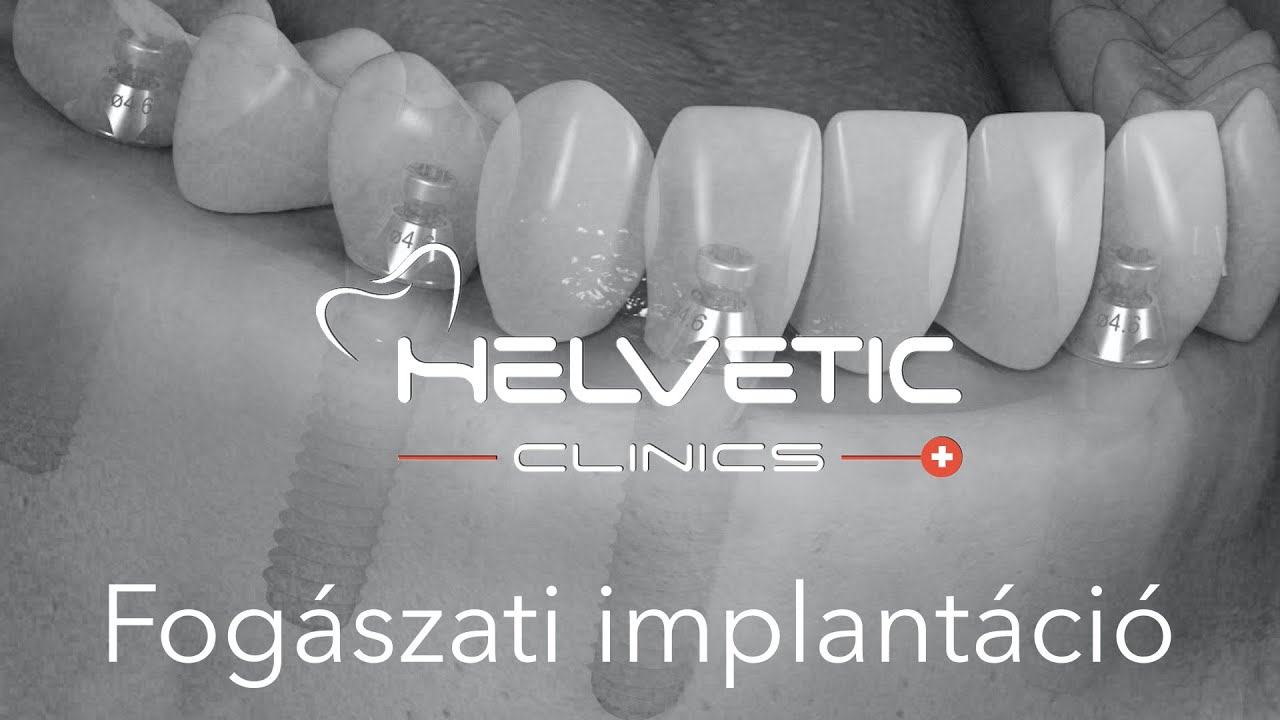 Fogászati implantátum beültetés - Helvetic Clinics - Dr. Berkei Gábor