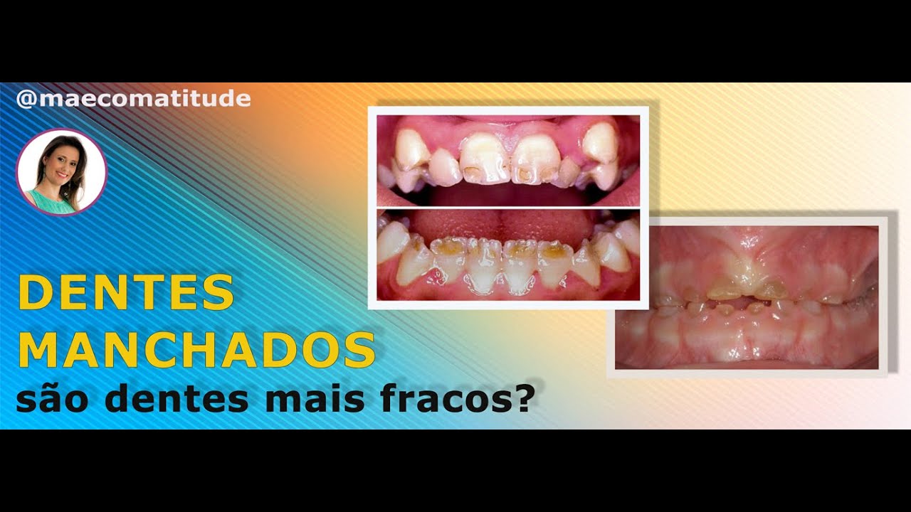 Dentes fracos,  manchas amarelas, marrons,  brancas, o quê fazer?