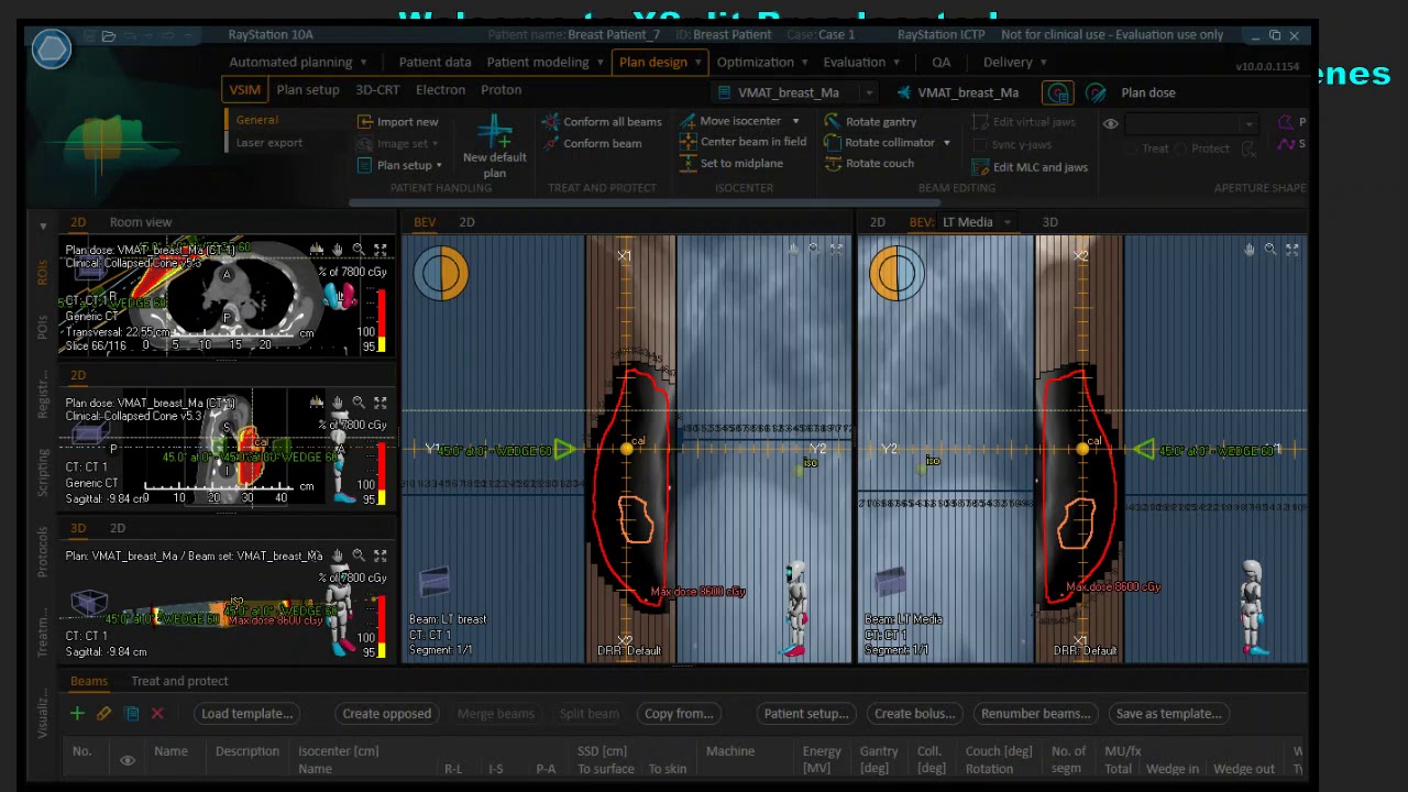 Breast 3D -CRT Planning using Raystation TPS