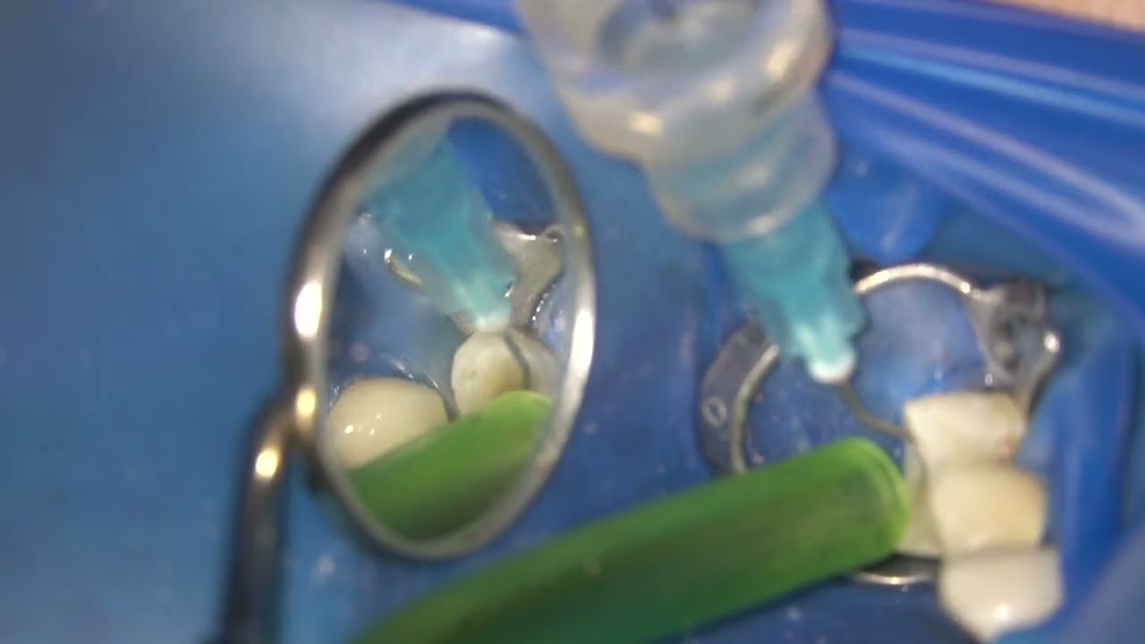 Root canals obturation and build up