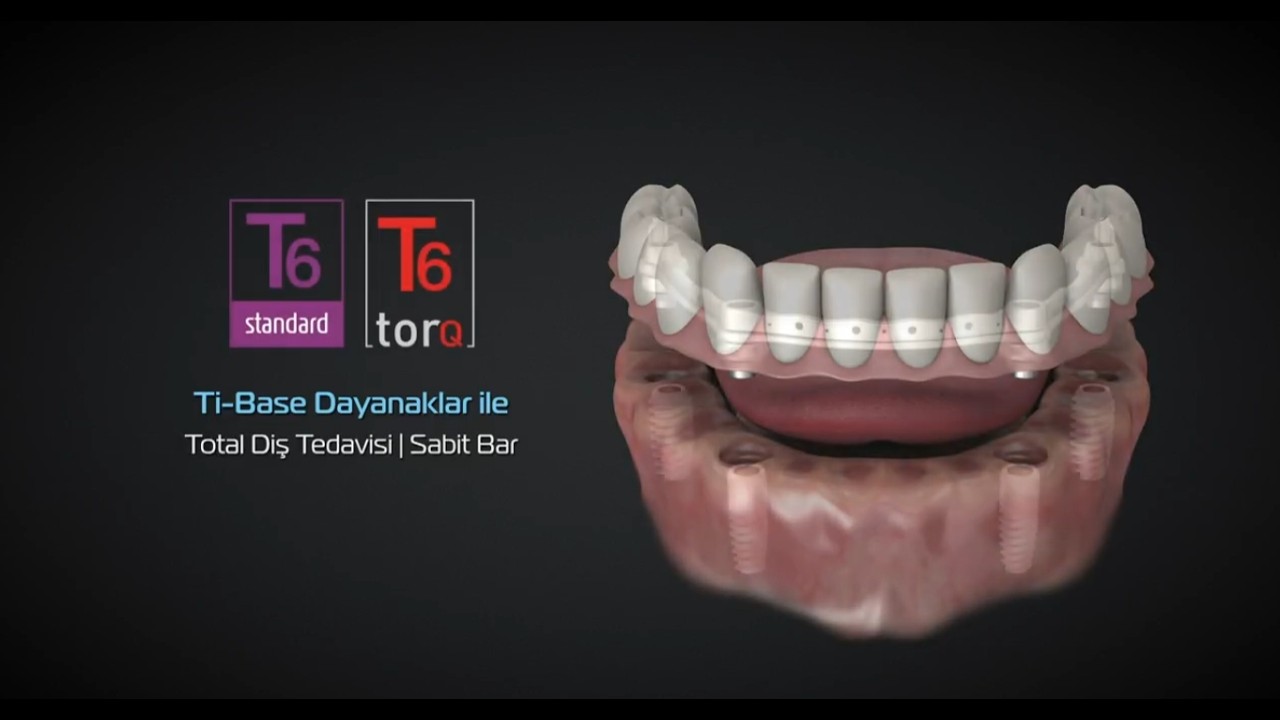 NucleOSS Ti-Base Dayanaklar | Total Diş Tedavisi | Sabit Bar