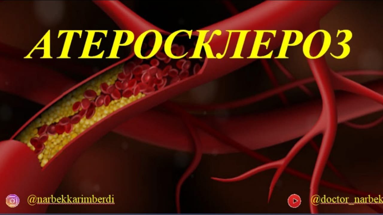 АТЕРОСКЛЕРОЗ | этиология, патогенез, симптомы, алдын алу шаралары