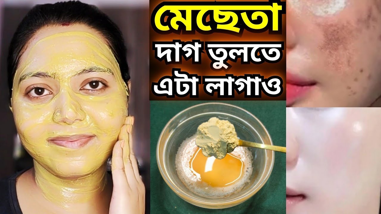 রাতারাতি মেছেতার দাগ তুলতে এটা আজই লাগাও/ মুখের কালো দাগ তোলার উপায়/mukher kalo dag tolar upay