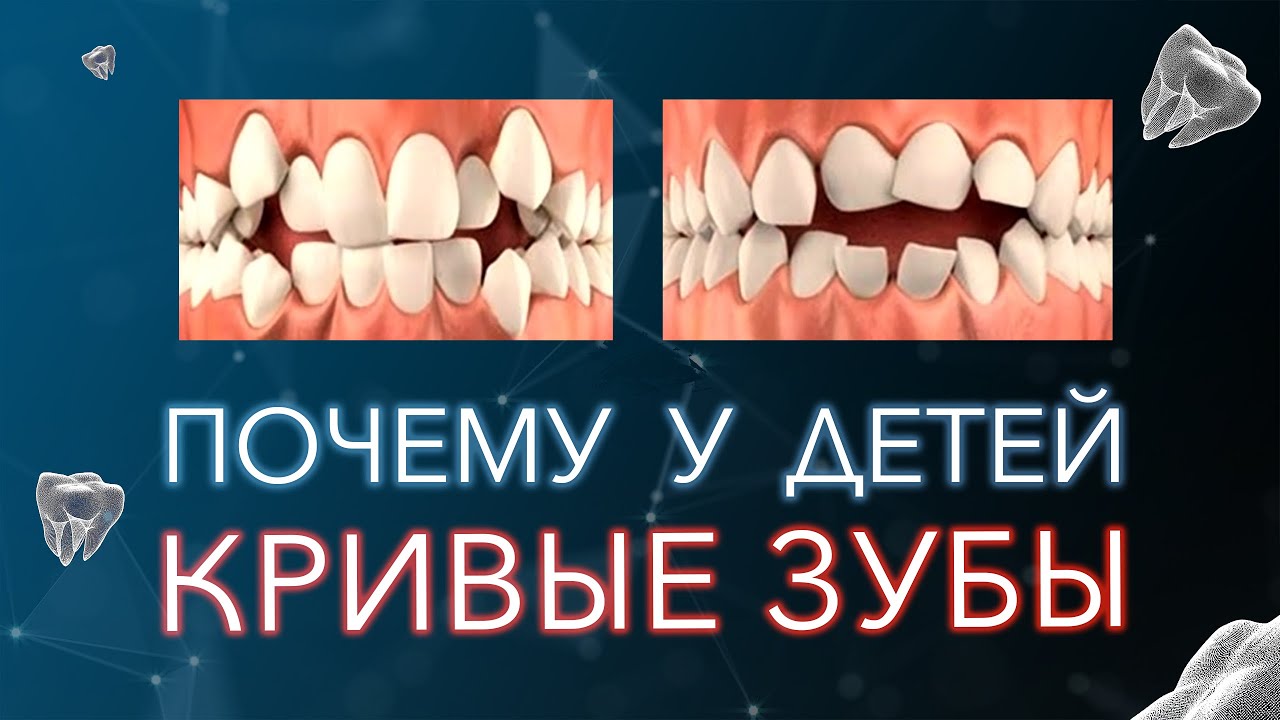 Кривые зубы у детей. Почему так происходит и что с этим делать.
