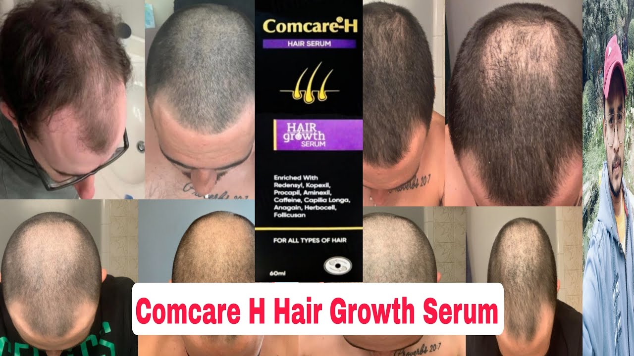 Comcare H Hair Growth Serum Review