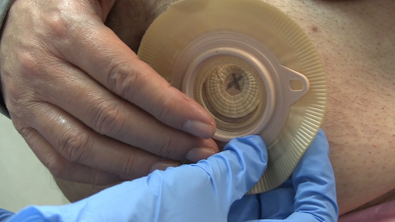 Formación de enfermeras expertas para atender a pacientes con ostomías