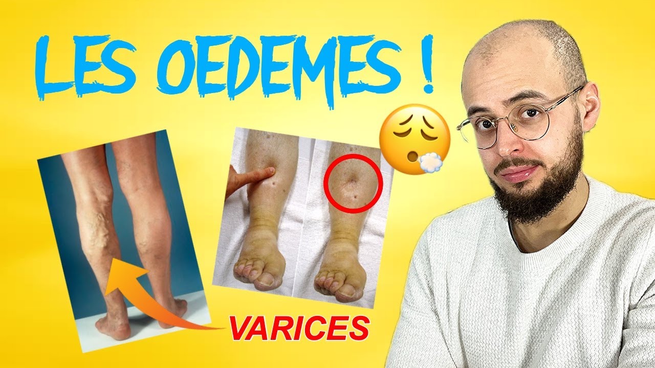 Les jambes qui gonflent. Pourquoi ? Quelles solutions ?