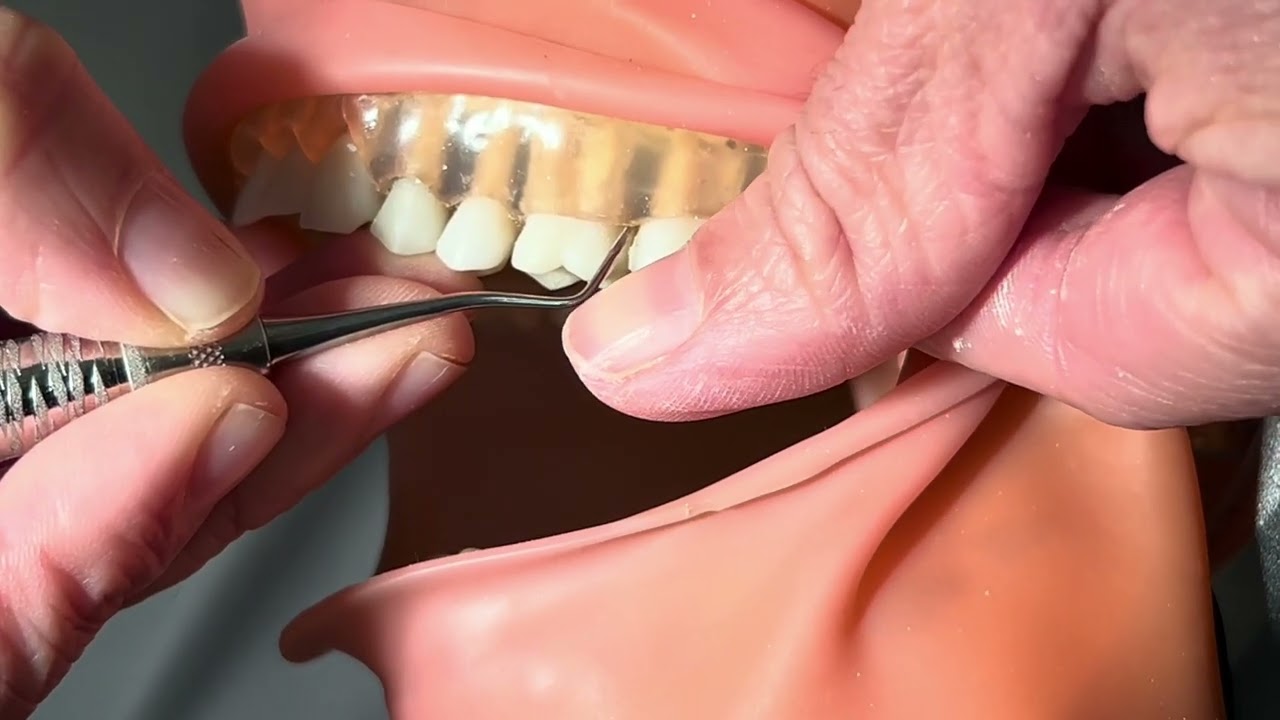 Lab #12 Strokes, Angulation, and Calculus Removal
