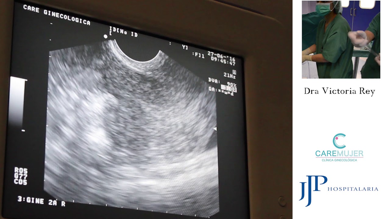 Ablación por radiofrecuencia de mioma uterino - Dra. Victoria Rey