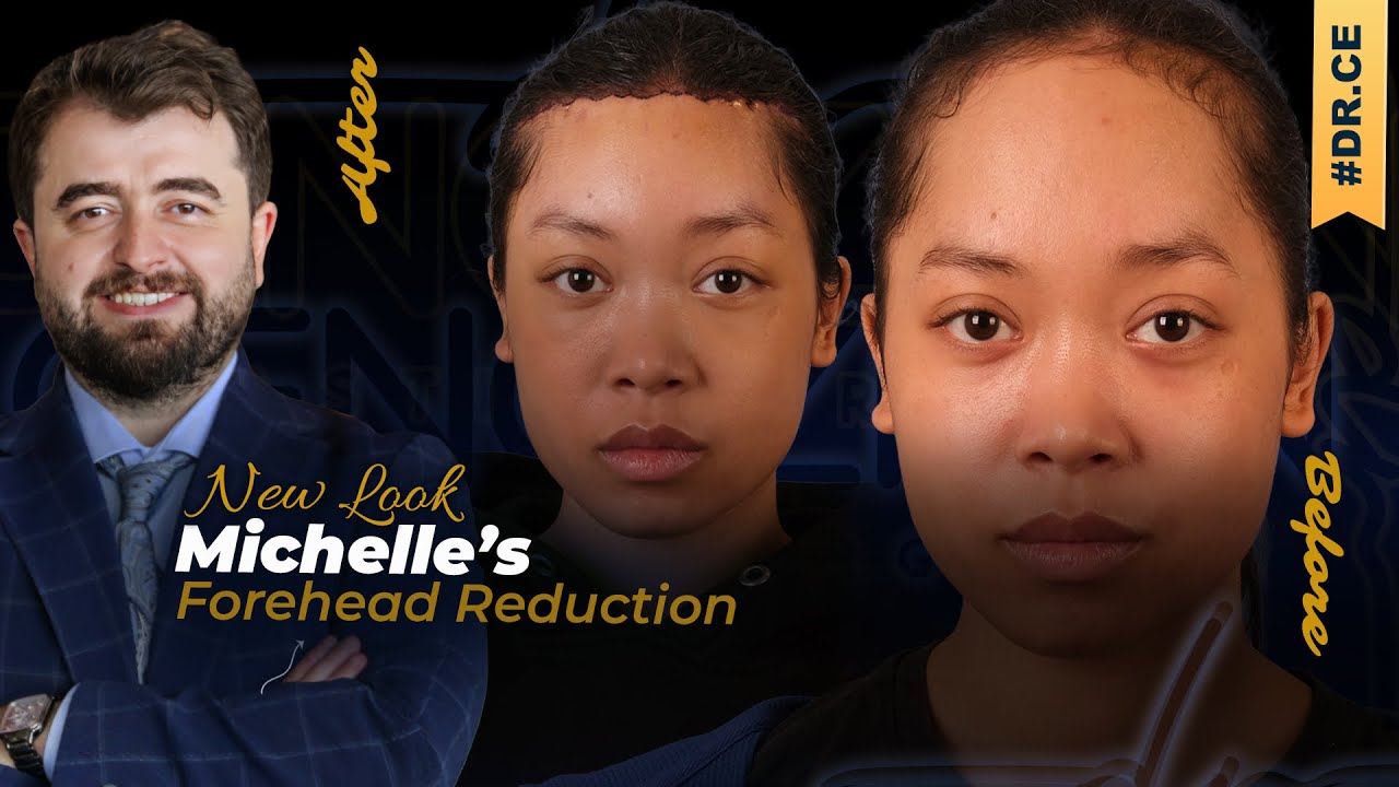 Achieving a Beautiful Forehead | Michelle's Forehead Reduction w/ Dr. Cengizhan Ekizceli
