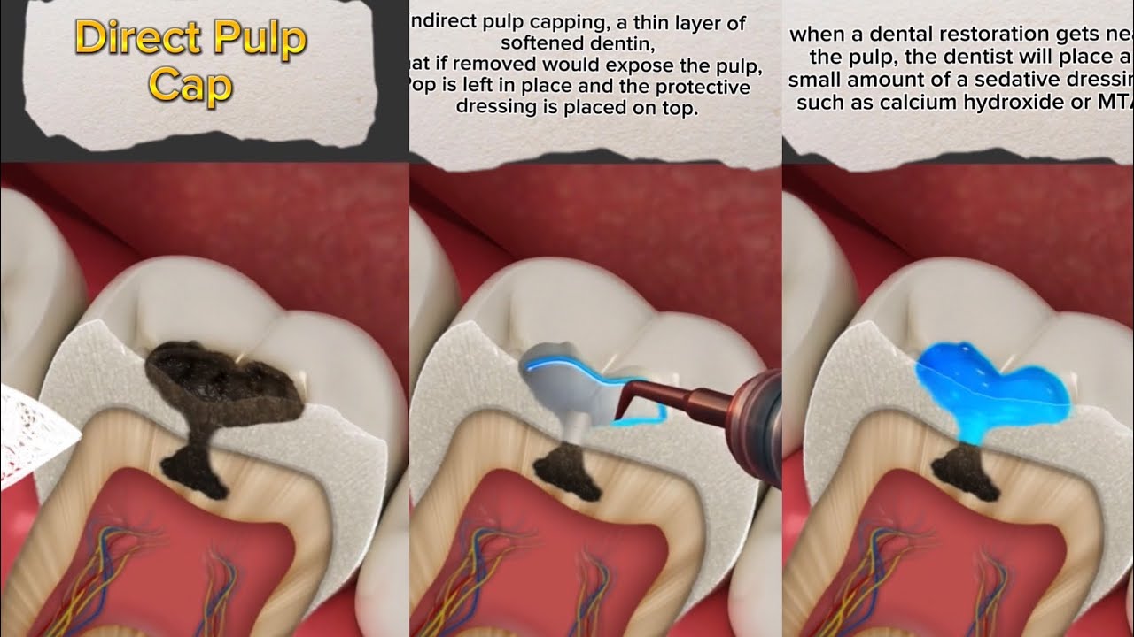Direct Pulp Cap
