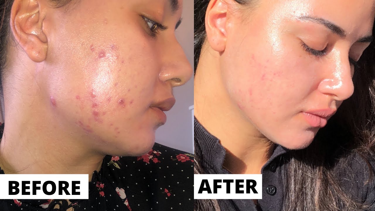 Tretinoin 3 month Update (FAITH RESTORED!! ) Tretinoin Before And After Results | DERMATICA