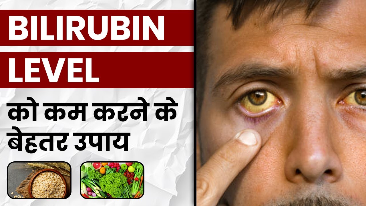 कैसे आहार के द्वारा Bilirubin Level को कम करें? | Foods That Help Lower Bilirubin Levels | SRIAAS