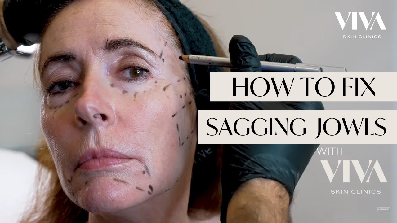 HOW TO FIX SAGGING JOWLS | DERMAL FILLER INJECTIONS VIVA 2023