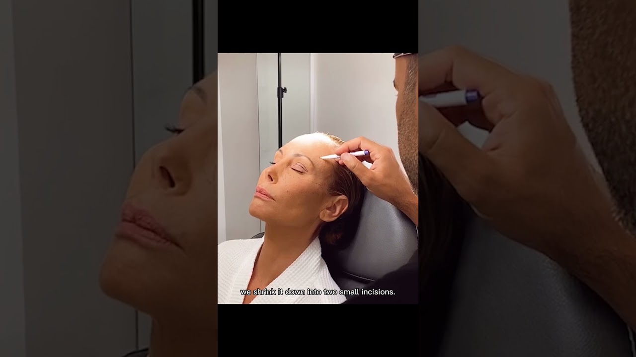 This is Brow Lift