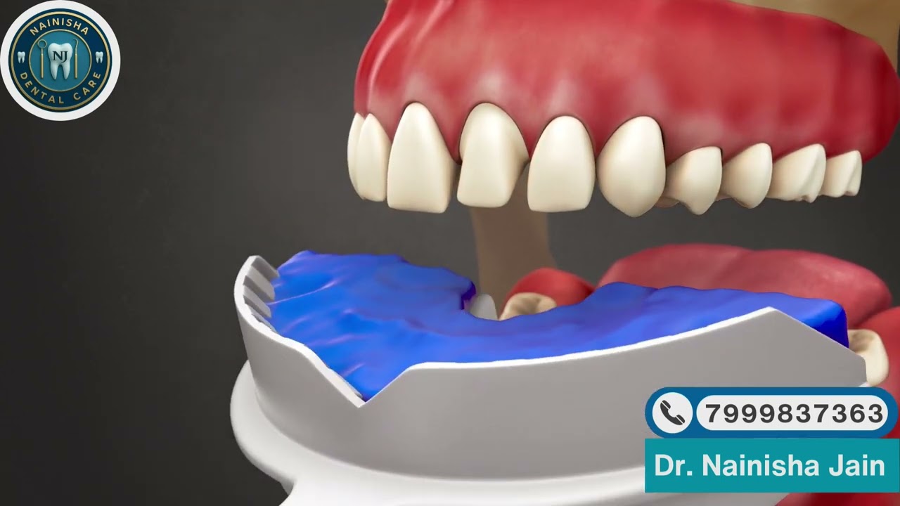 Porcelain Crown Explained – A Natural, Metal‑Free Smile| Dr.Nainishha Dental Care