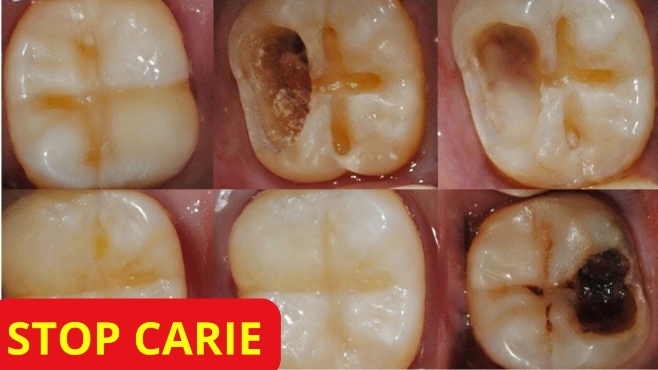 Carie ai denti? 4 metodi semplici che possono fare la differenza