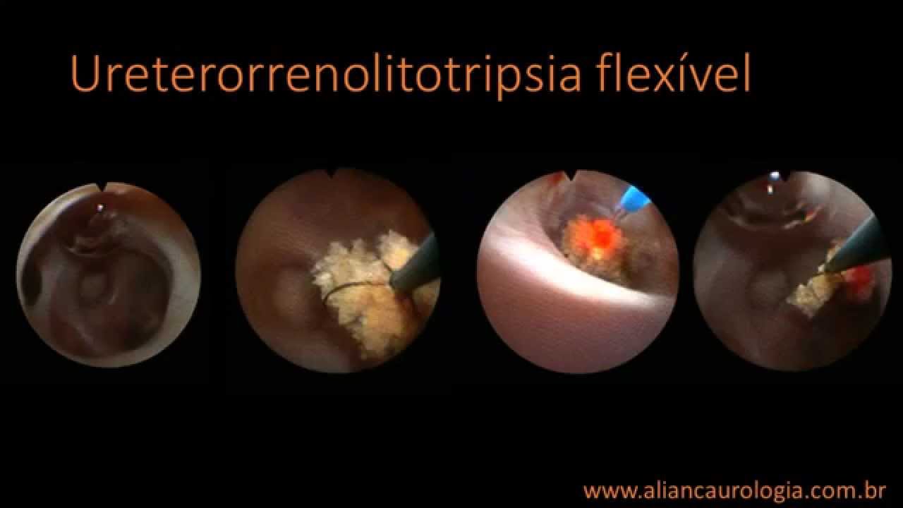 Ureterorrenolitotripsia Flexivel