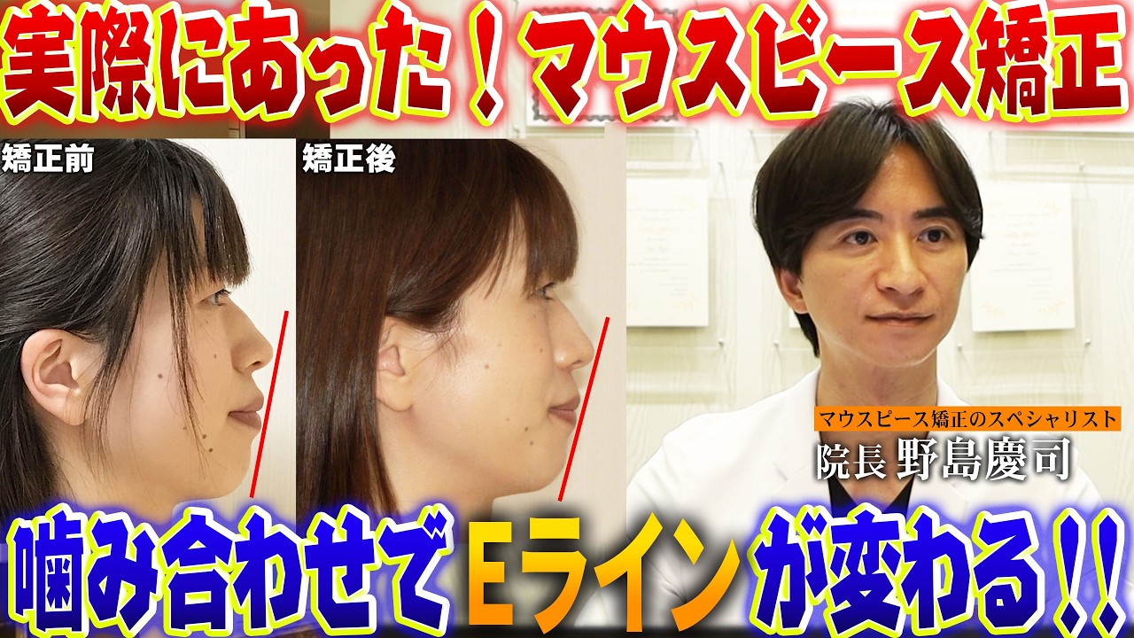 マウスピース矯正で噛み合わせが改善！結果…フェイスラインに驚きの変化が！夫婦で一緒に矯正を始めた女性の実際にあった症例シリーズ