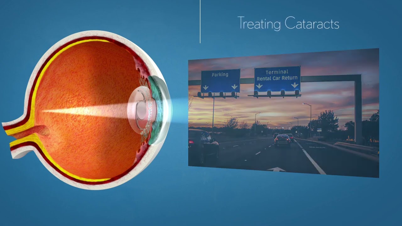 Unlock Clear Vision: enVista Toric Cataract & Astigmatism Solutions
