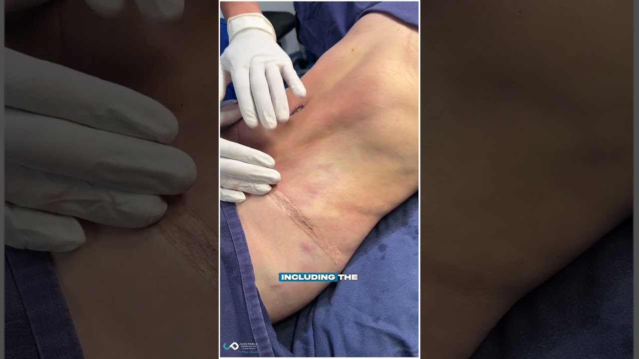 Abdominoplastia de alta definición