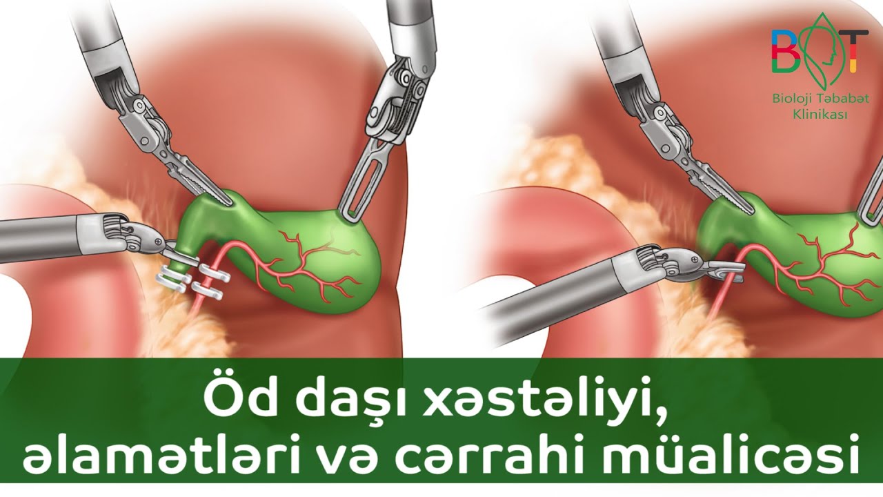 Öd daşı xəstəliyi, əlamətləri və cərrahi müalicəsi