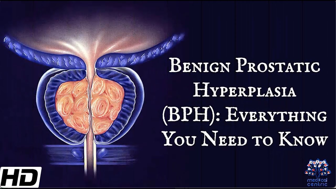 Benign Prostatic Hyperplasia (BPH): Everything You Need To Know