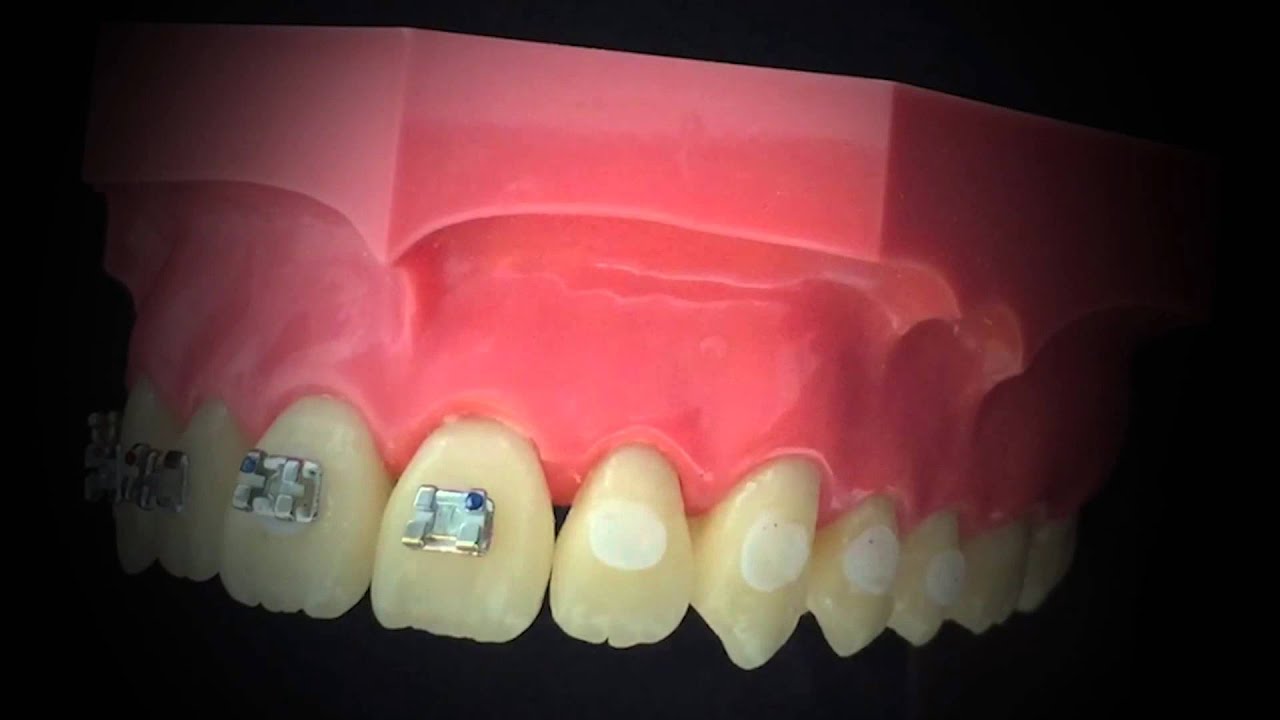 Biodinâmica | Biofix: Adesivo para fixação de brackets com fluorescência