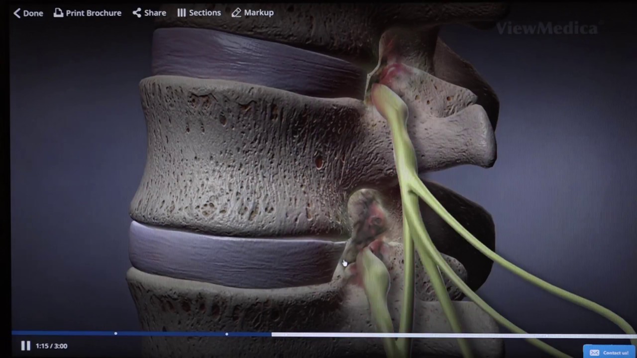 Dr. Sameer Mathur discusses how to perform a Lumbar Laminectomy