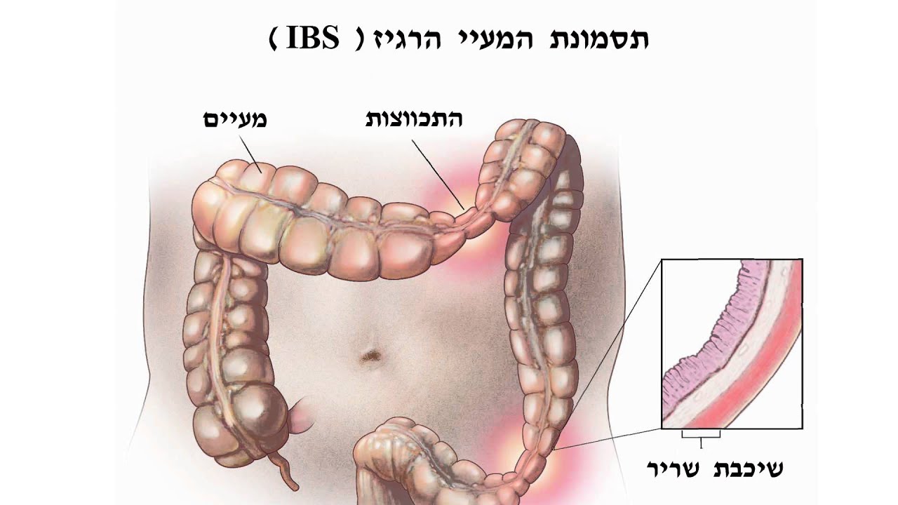 תסמונת  המעי  הרגיז - טיפול  בהיפנוזה רפואית