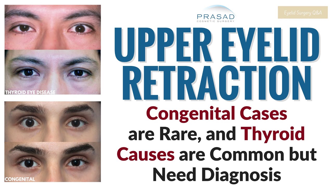 How One can be Born with One Eye Appearing Larger, or Develop it Later in Life