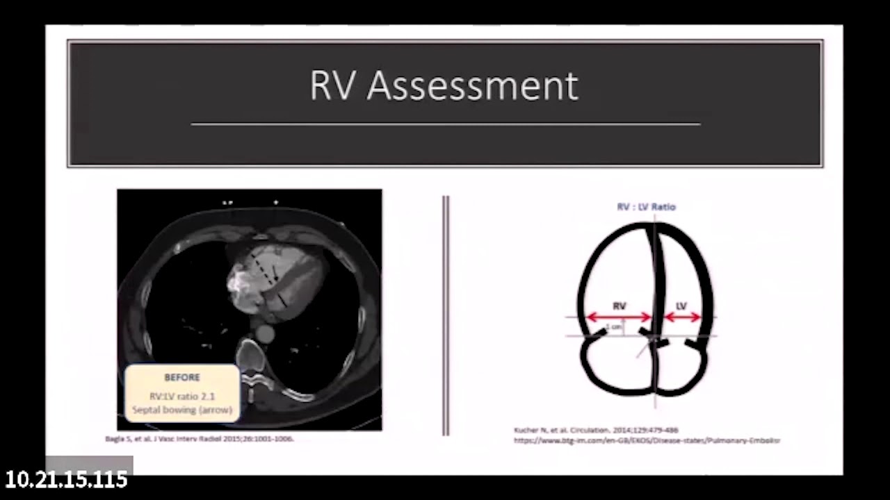 Advanced Treatment for Acute PE